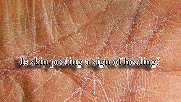 Is skin peeling a sign of healing?